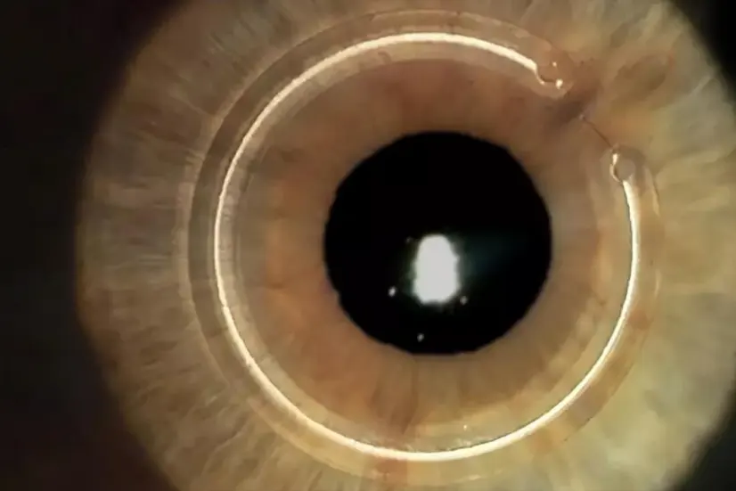 ceratocone anel estromal oftalmologista em itaituba